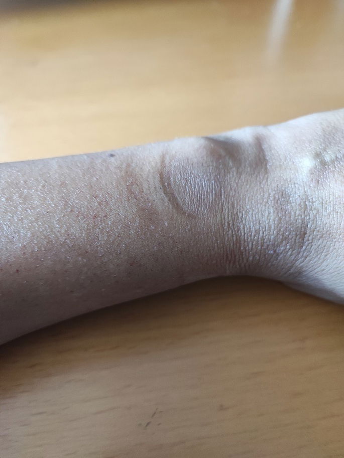 imagem da marca do pulso depois da utilização do smartwatch